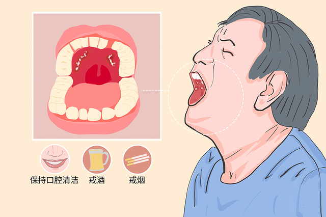 杭州御和堂中医解答：识别口腔癌的方法。