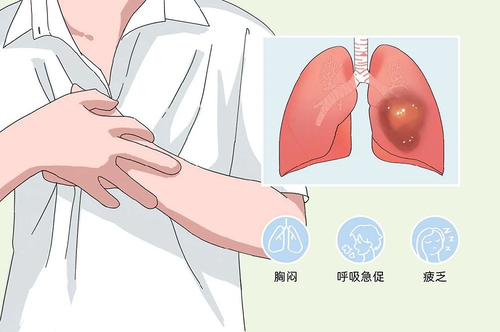 遇见肺大泡怎么办？中医如何治疗肺大泡？