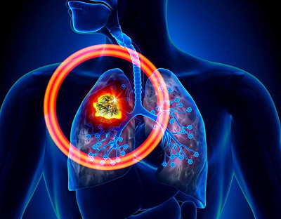 杭州御和堂中医：怎么才能治肺癌晚期?