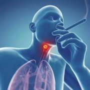 喉癌转移的症状有哪些？这些症状需要早知道！